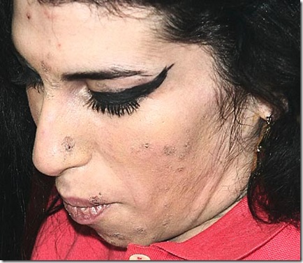 amy winehouse scabs and spots coverd face picture