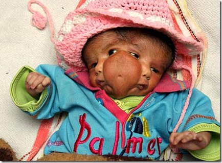 Cranofacial Duplication Indian Baby Lali  Born With Two Faces picture