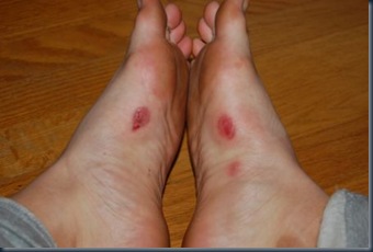 blisters1