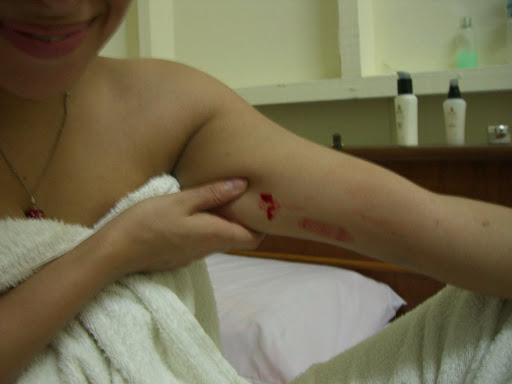 Becky's bleeding leech wound!