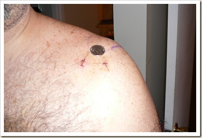 Showing the scale of the incisions.